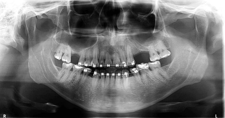 Reabsorción radicular