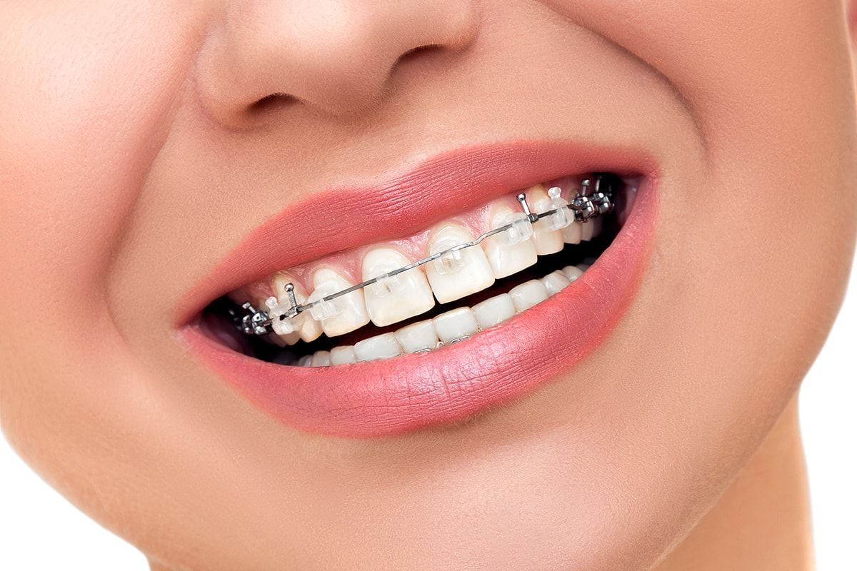 Brackets Esteticos Beneficios02