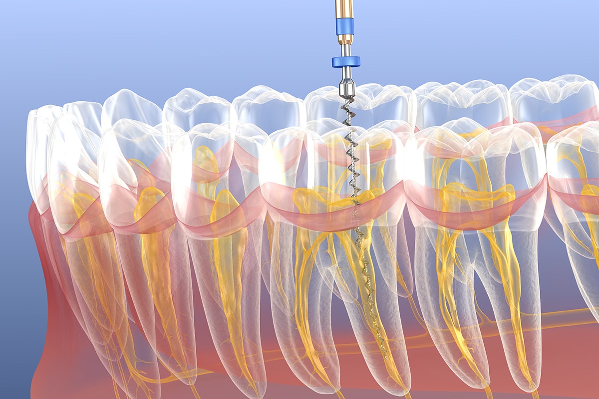 Endodoncia Proceso02