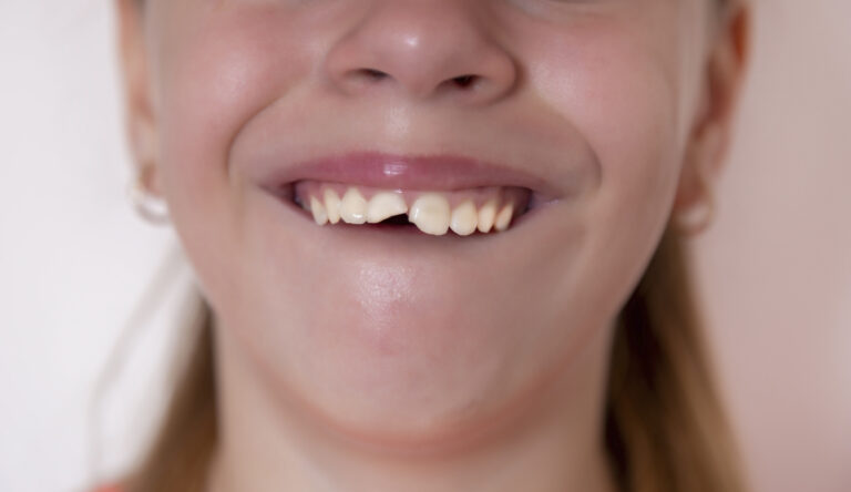 Urgencia dental infantil