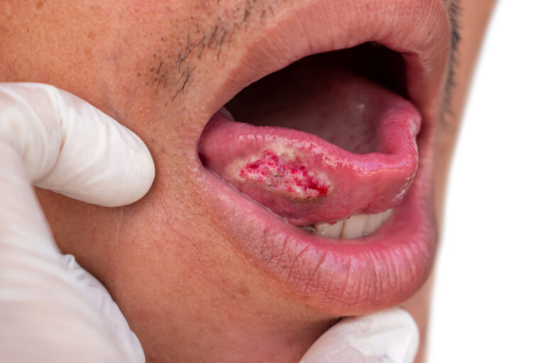 Cáncer oral: factores de riesgo y signos tempranos