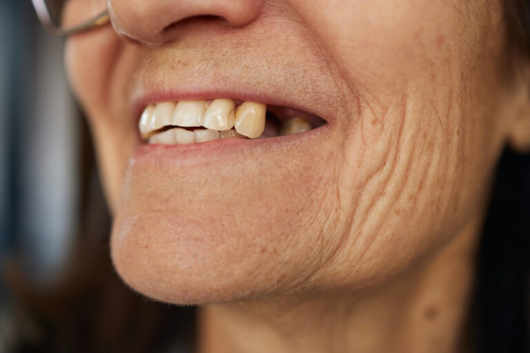 señales tempranas de pérdida ósea dental