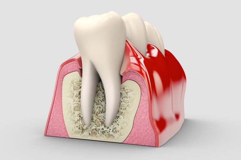 Tratamientos Periodoncia